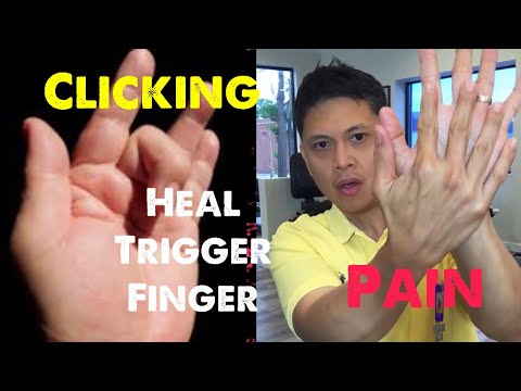 Video: Paano Magamot ang Trigger Finger: 8 Hakbang (na may Mga Larawan)