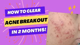 How my ACNE BREAKOUTS Healed in 2 Months! / CLEAR ACNE | ATE Monik
