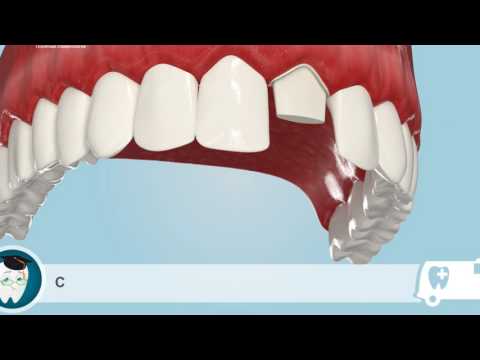 Зубные коронки  Установка зубной коронки на передний зуб