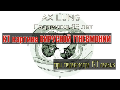 КТ картина ВИРУСНОЙ ПНЕВМОНИИ при двусторонней полисегментарной пневмонии на РАСШИФРОВКЕ КТ легких