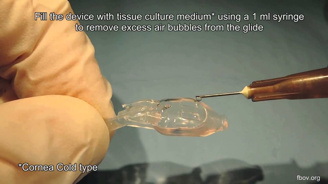 PRE-LOADED LENTICULE PREPARATION FOR (UT)DSAEK