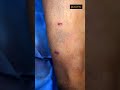 Lipoma Removal