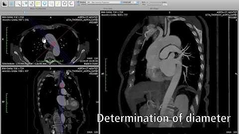 Planning of Aorta Stent Grafts