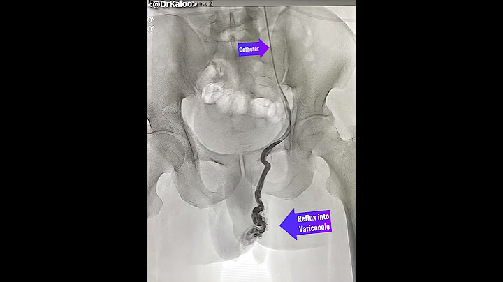 Varicocele Embolisation Angiography (venogram) of left gonadal vein in a man suffering from