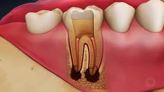 K Tedavisi Nasıl Yapılır ? Animasyonlu Anlatım