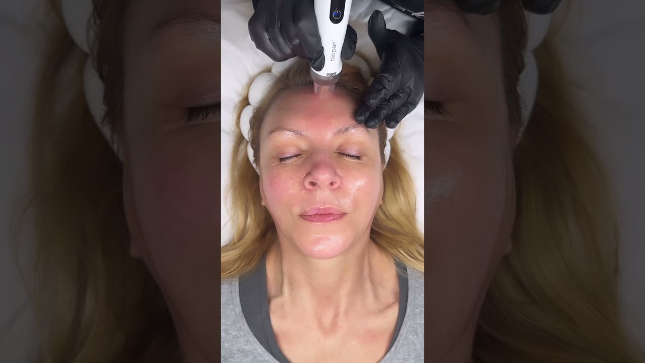 Introducing the NEW Bio Pen Q2 Microneedling Pen. - YouTube