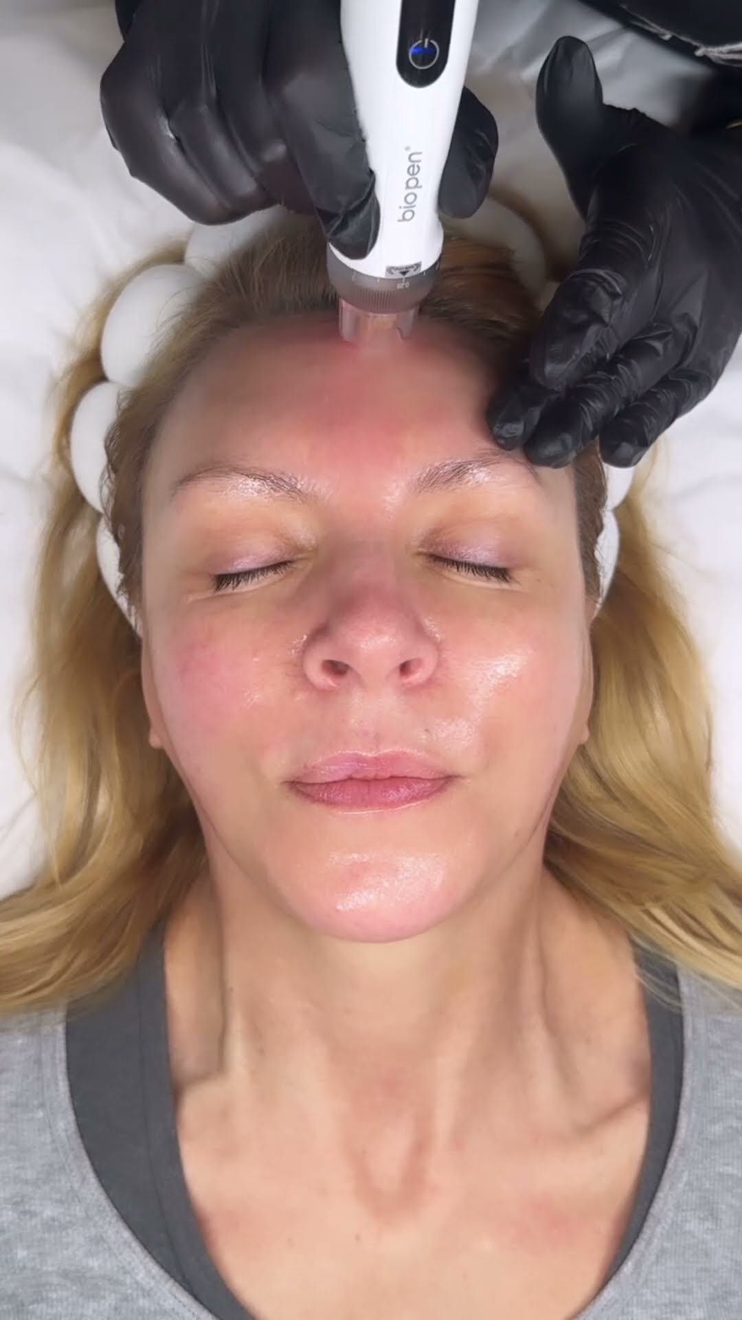 Introducing the NEW Bio Pen Q2 Microneedling Pen. - YouTube