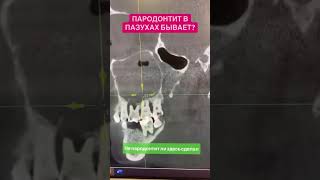 Одонтогенные и локализованные очаги инфекции Зубов верхней челюсти