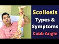 Scoliosis, Types of Scoliosis, Cobb Angle, Scoliosis Treatment, Scoliosis Symptoms