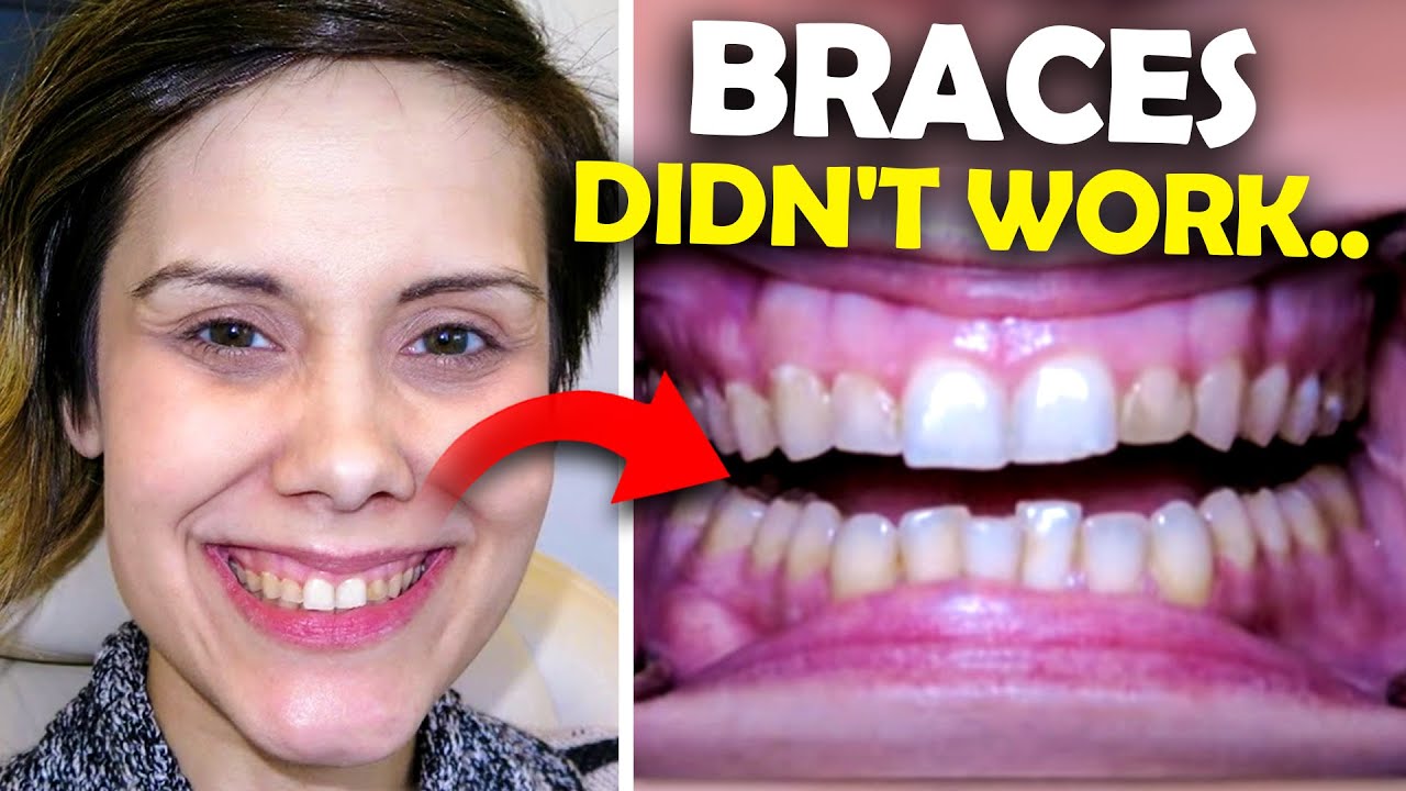 Braces made her teeth worse...Orthodontist REACTS YouTube