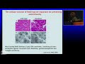 Autoantigens and autoimmunity: a bedside to bench and back again story