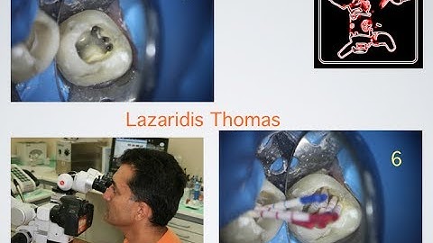 midlemesial without....handfile