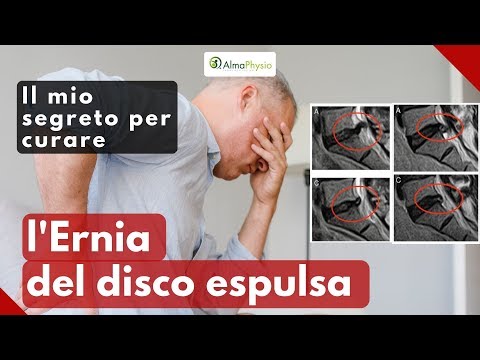 Video: 3 modi per recuperare da un'ernia del disco