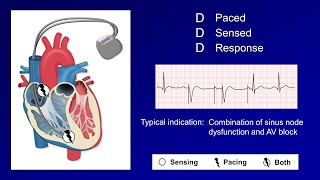 Pacemaker Modes and Settings