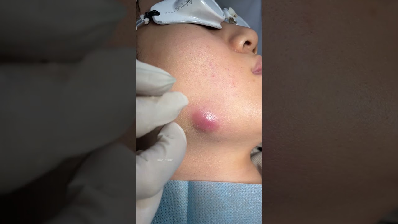 Mụn áp xe ở má sưng viêm to