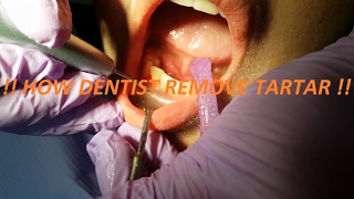 Professional Teeth Cleaning !!! [ How Dentist Remove Tartar ]