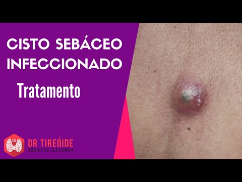 Cisto sebáceo infeccionado - Tratamento - Drenagem do Abscesso