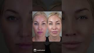 VI Peel | Dr. Paul Nassif