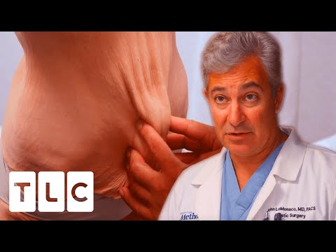 Dr. LoMonaco Has Never Seen This Type Of Excess Skin On Legs Before | My Extreme Excess Skin