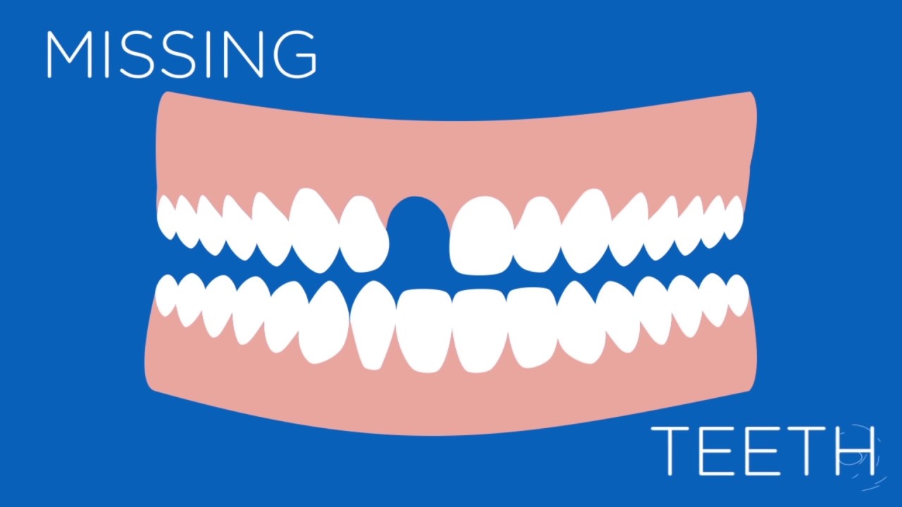 What Are Dental Implants - How Can They Help You?