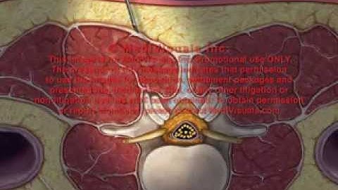 Lumbar Transforaminal Epidural Injection Animation