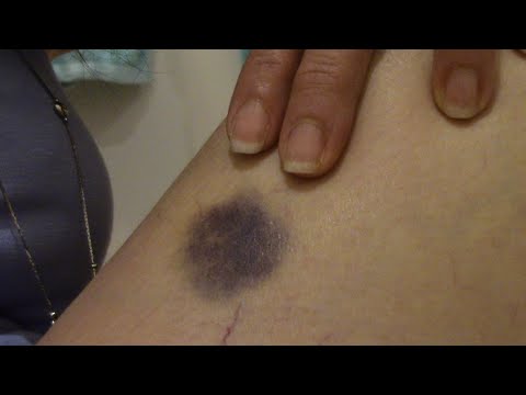 How to heal a bruise fast!