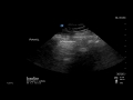 Lung Ultrasound Image Interpretation