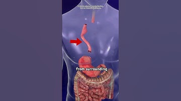 Esophagectomy Surgery 3D Animation