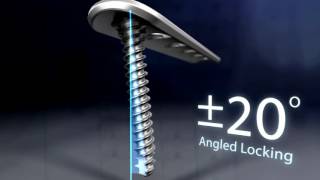 ExtremiLOCK Ankle Plating System Features