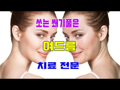 쏘는 쐐기풀은 여드름 치료 전문|매일 건강하게