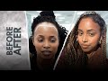 Afro Female Hairline Restoration with Hair Transplant - 12 Months - Before and After #hairtransplant