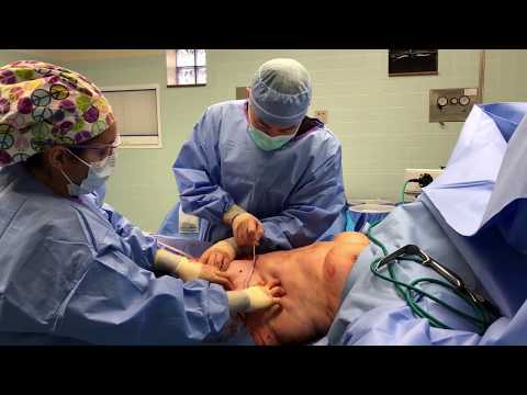Video: Liposuction: Indications And Features Of The Procedure