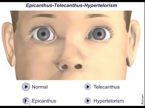 Эпикантус-телекант-гипертелоризм