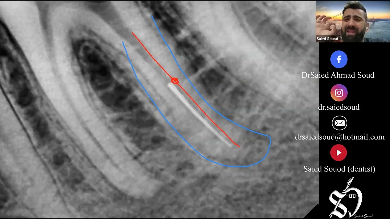 Bypass of broken file ( case discussion) . Dr Saied Saoud
