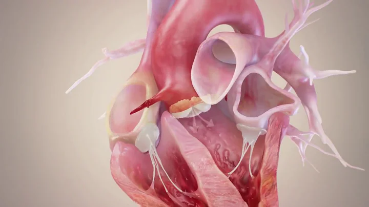 Bicuspid Aortic Valve, Anatomy and Potential Complications