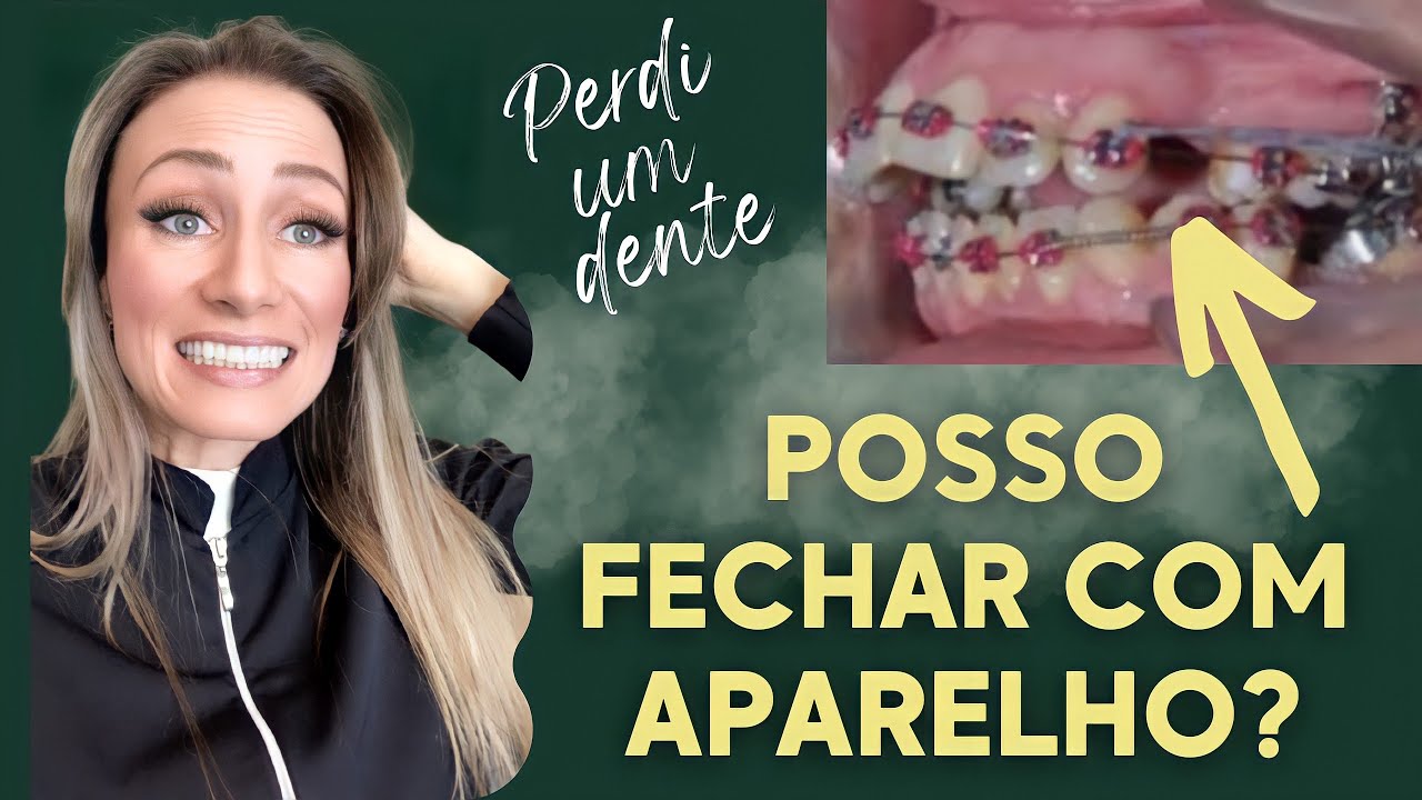 É possível fechar um espaço com aparelho? Ou faço implante? 