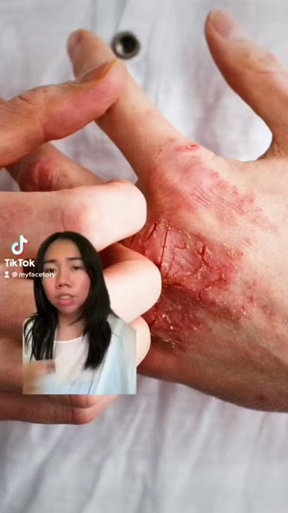 Download lagu Do you have Eczema? | FaceTory