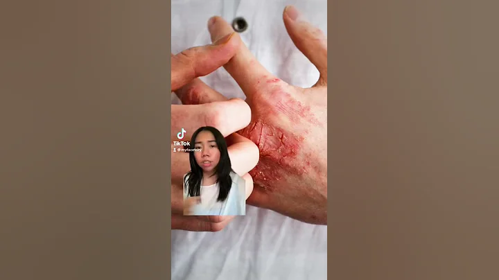 Do you have Eczema? | FaceTory - DayDayNews