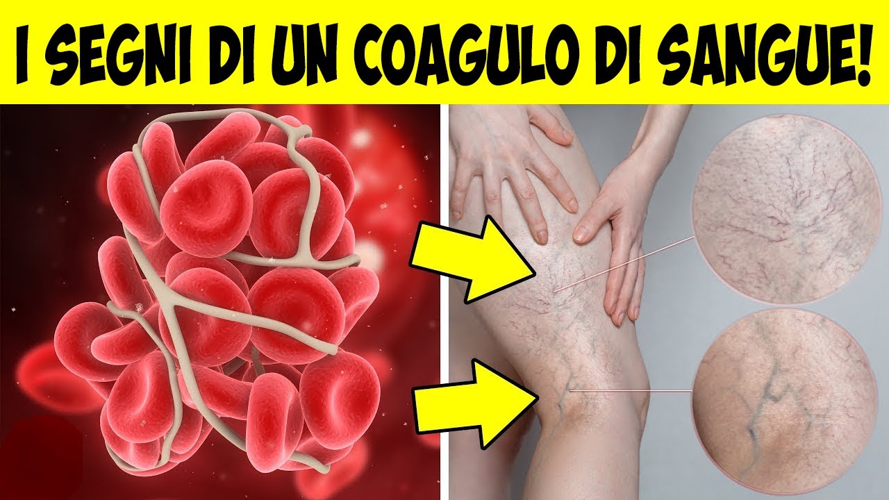 Coagulo Di Sangue Nelle Urine macamiaan Coagulo Di Sangue Nelle Urine macamiaan