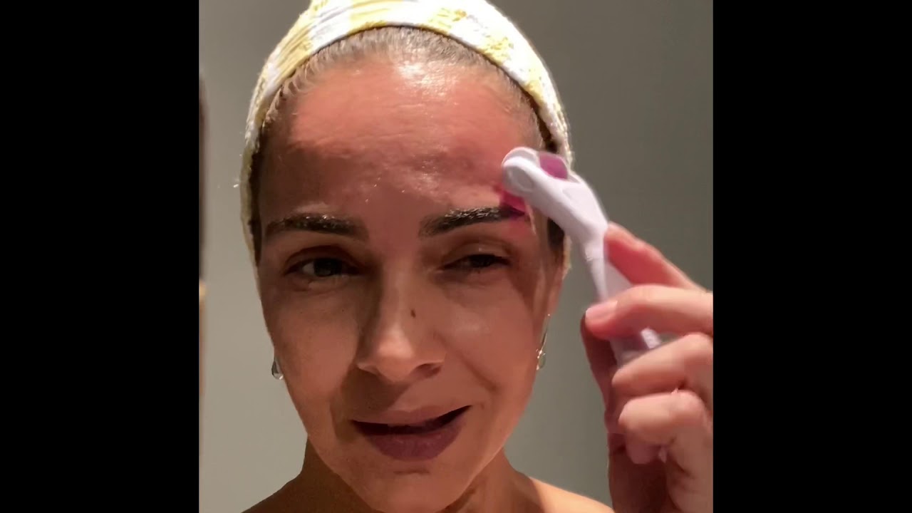 Microagulhamento antes e depois 5 meses - YouTube