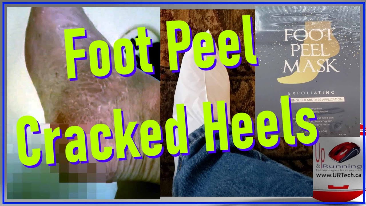 Foot Peel A Mans Cracked Feet & Heels at Home YouTube