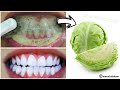 Teeth whitening in just 2 minutes - how to whiten teeth at home 100% effective