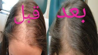 علاج تساقط الشعر الفعال وصفة طبيعية لانبات الشعر وملئ الفراغات من جديد
