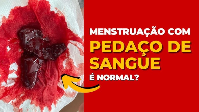 Coágulos na menstruação: isso é normal?