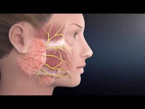 Video: Adenoma Kelenjar Air Liur Parotid, Rawatan