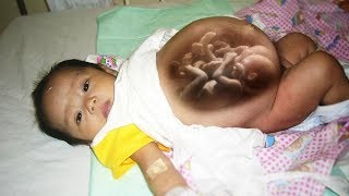 "БЕРЕМЕННЫЙ МЛАДЕНЕЦ" в Китае на свет появилась девочка беременная двойней