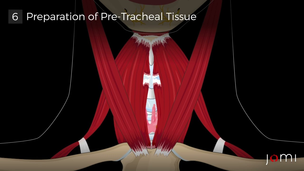 Transoral Endoscopic Thyroidectomy Vestibular Approach (TOETVA) Steps