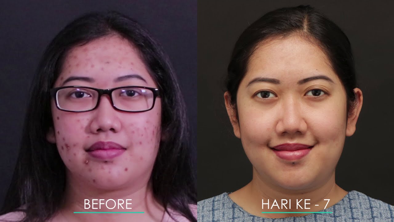 Bebas Jerawat Dalam 1 Minggu Transformasi Acs 1 Youtube