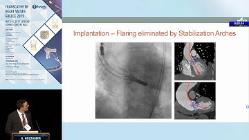 A. Holzamer  | The ACCURATE Neo TAVR system. Program Update, clinical data, patient selection and...