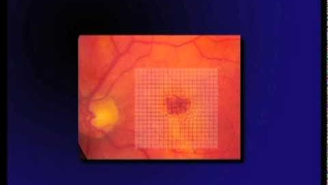 Metamorphopsia - The 15 Visual Problems of Macular Degeneration